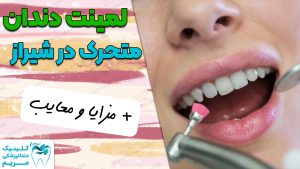 لیمنت متحرک دندان شیراز
