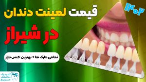 قیمت لمینت دندان شیراز
