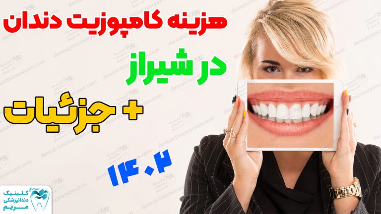 هزینه کامپوزیت دندان شیراز چنده؟